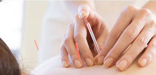 針・灸